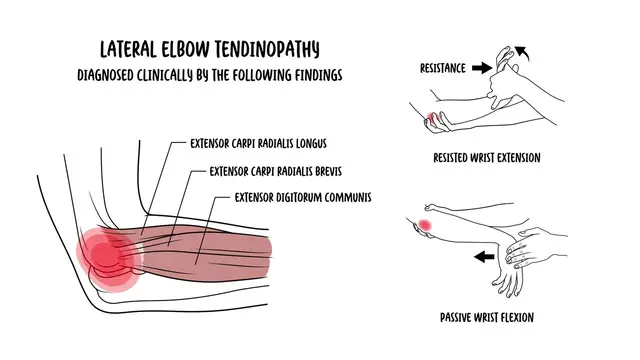 Understanding Tennis elbow - lateral elbow tendinopathy (lateral epicondylitis)